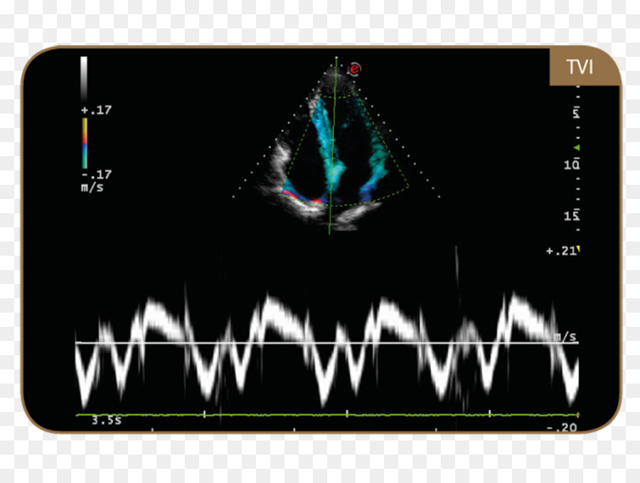التصوير بالموجات فوق الصوتية，الأنسجة تخطيط صدى القلب دوبلر PNG