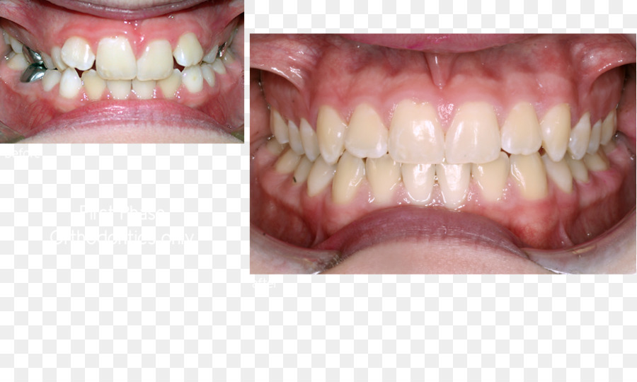 الأسنان，أطقم الأسنان PNG