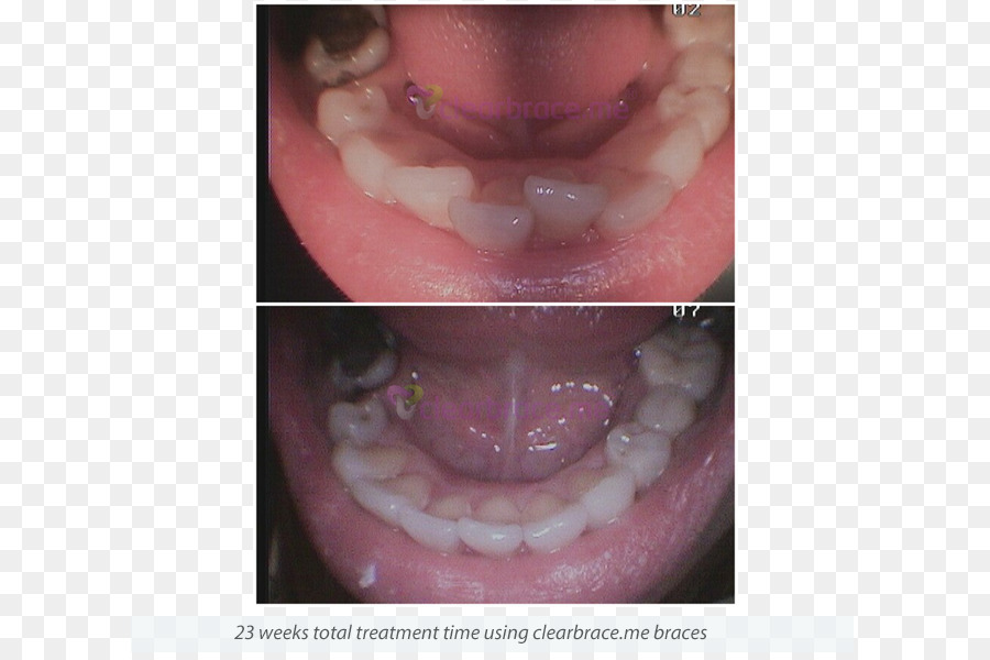 الأسنان，أطقم الأسنان PNG