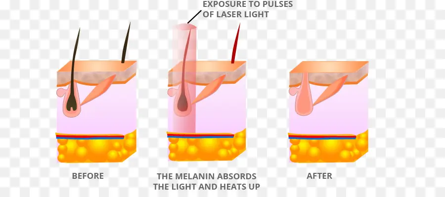 إزالة الشعر بالليزر，جلد PNG