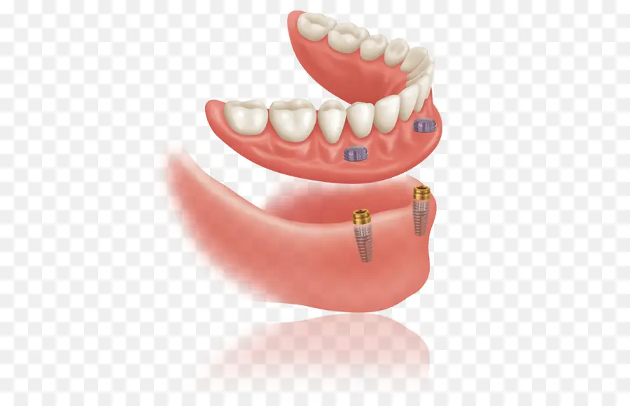 أطقم الأسنان，زرع الأسنان PNG