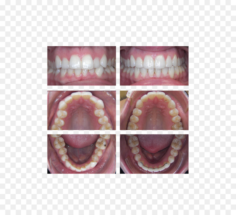 المقربة ،，الأسنان PNG
