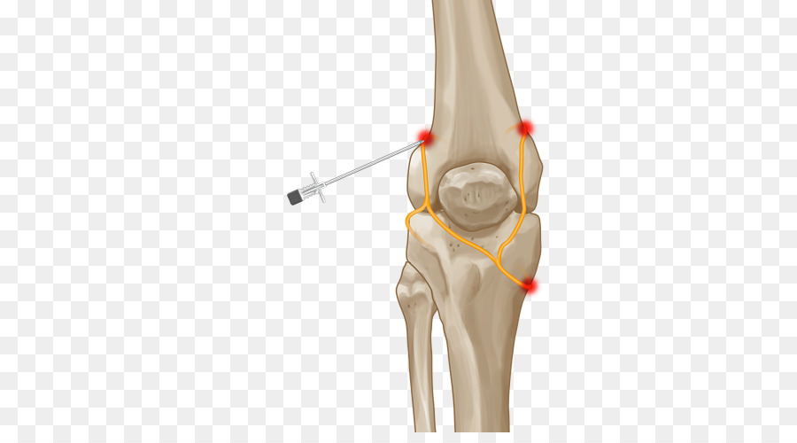 رسم توضيحي لجراحة الركبة，ركبة PNG