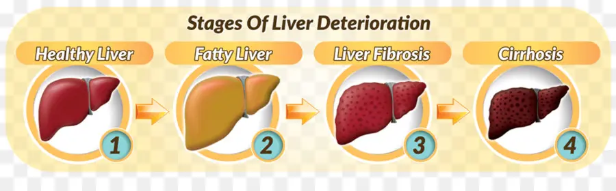 مراحل تدهور الكبد，الكبد PNG